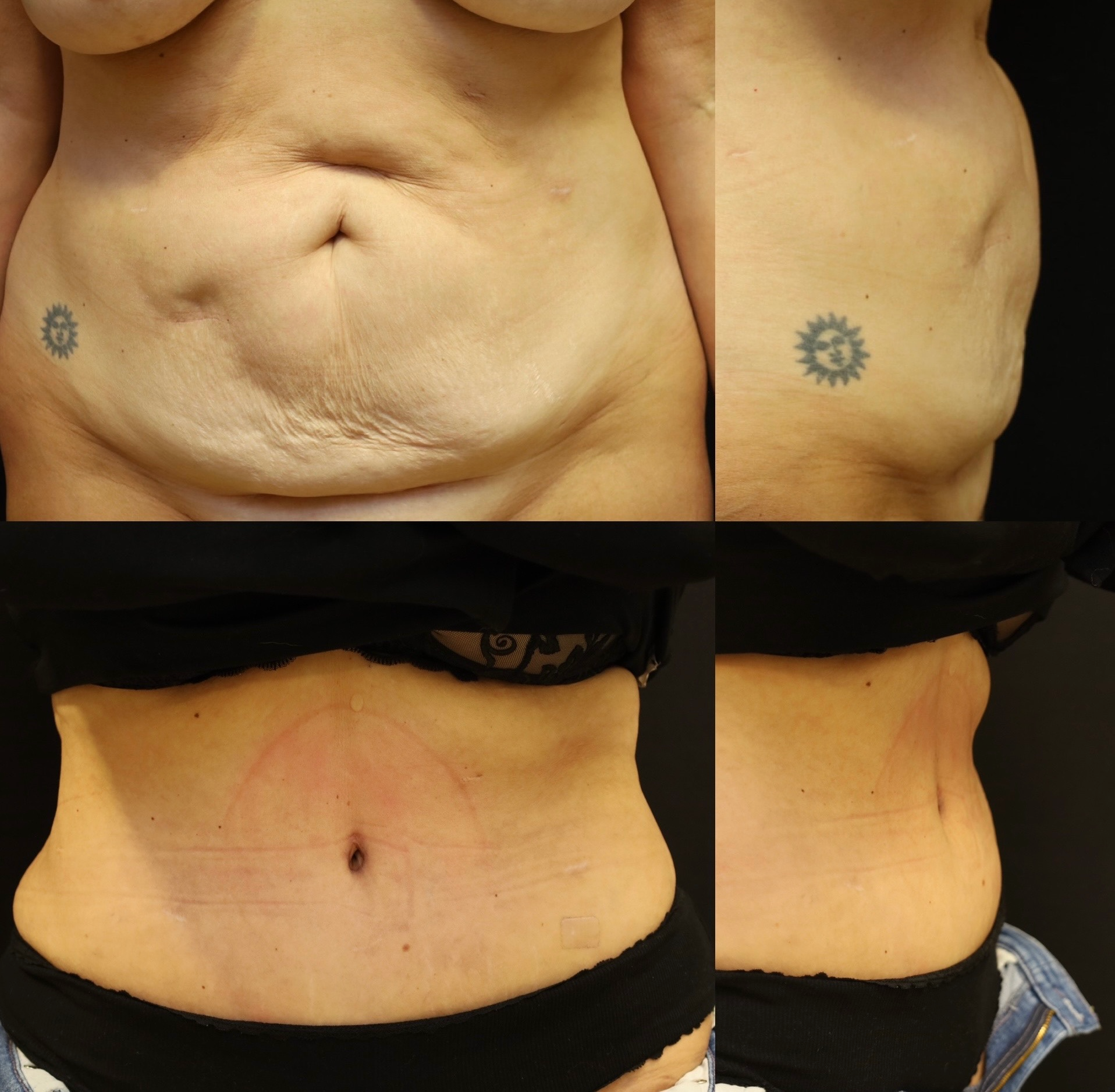 Abdominoplasty Case 11