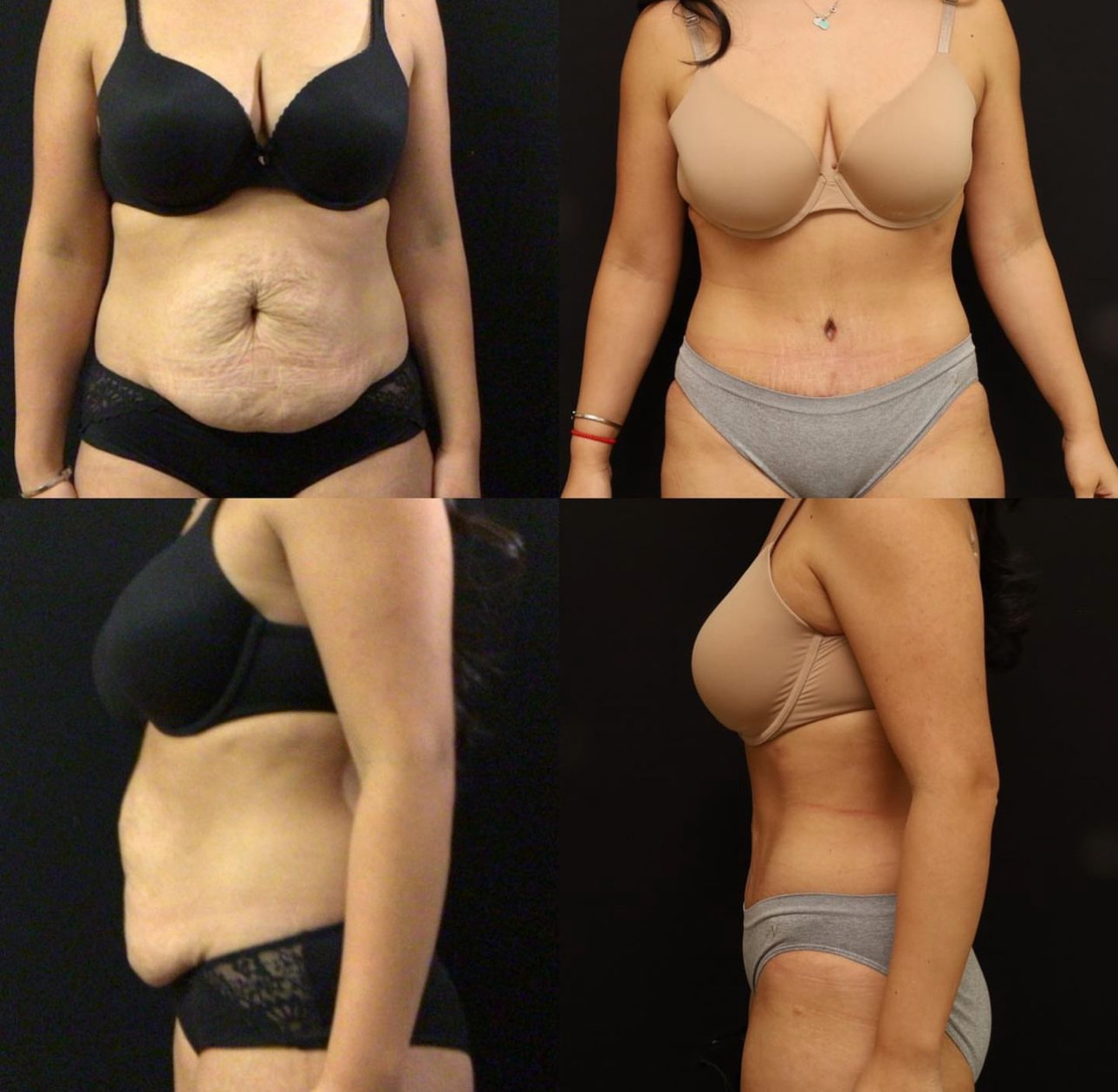 Abdominoplasty Case 14