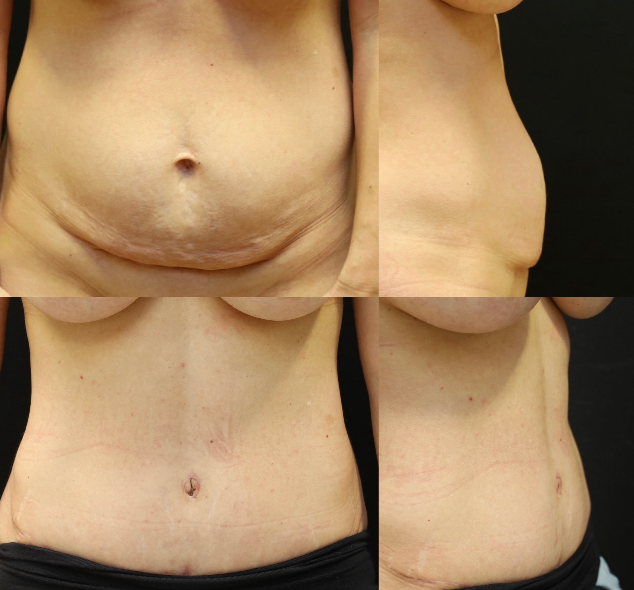 Abdominoplasty Case 4