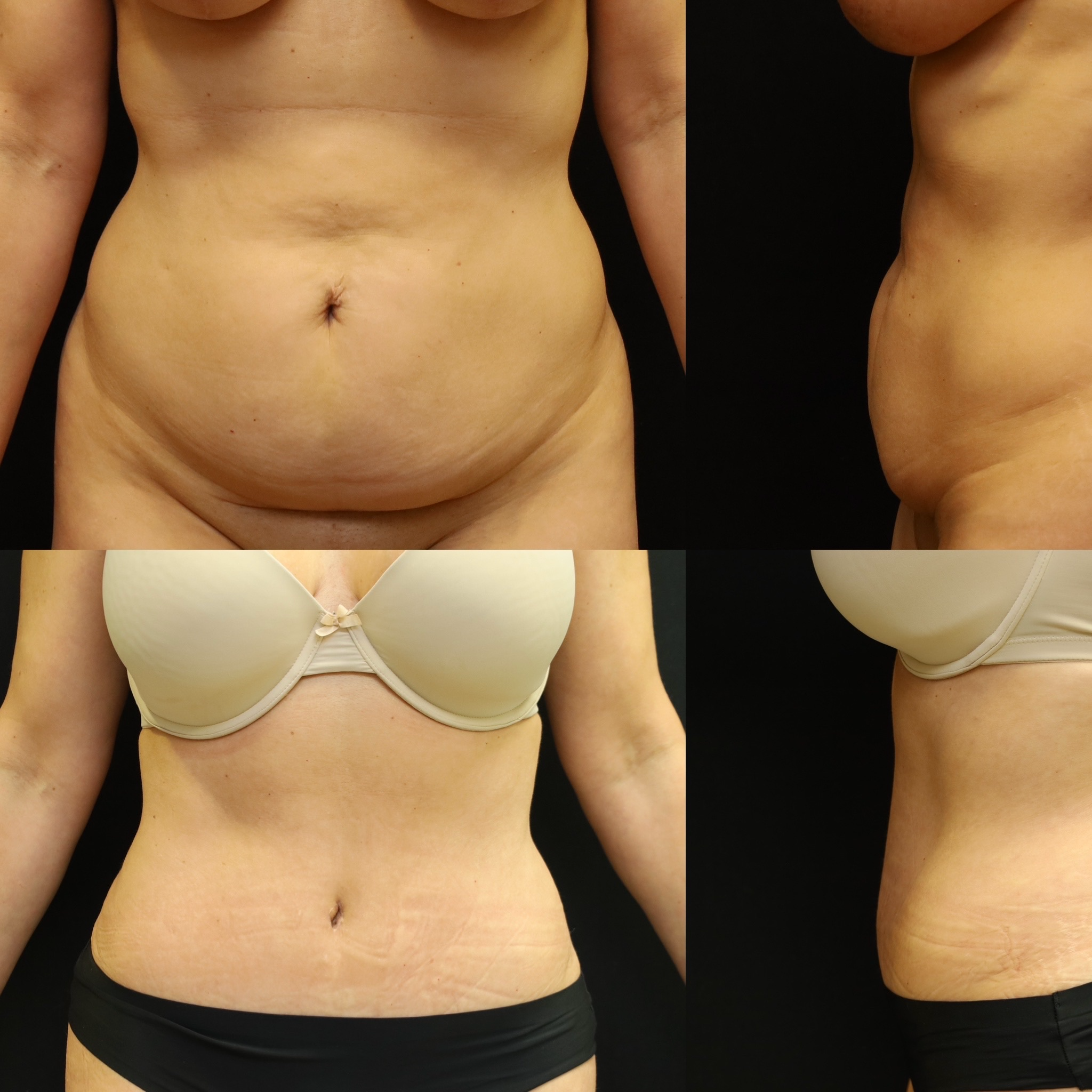 Abdominoplasty Case 8