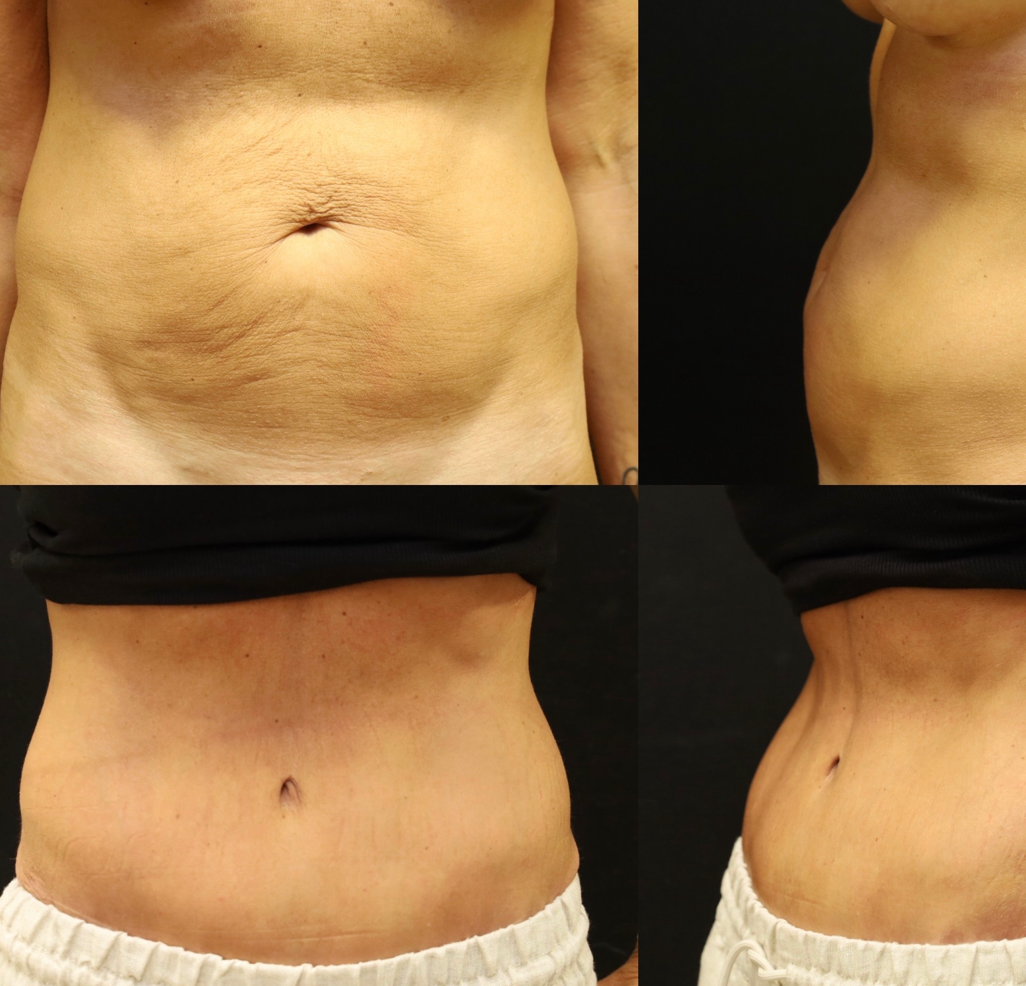 Abdominoplasty Case 9