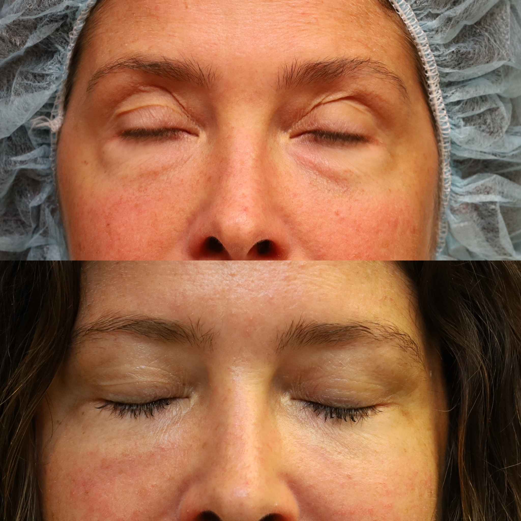 Blepharoplasty Case 5