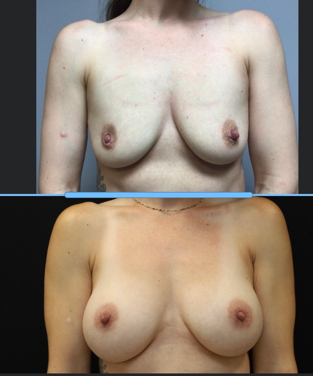 Breast Augmentation Case 11