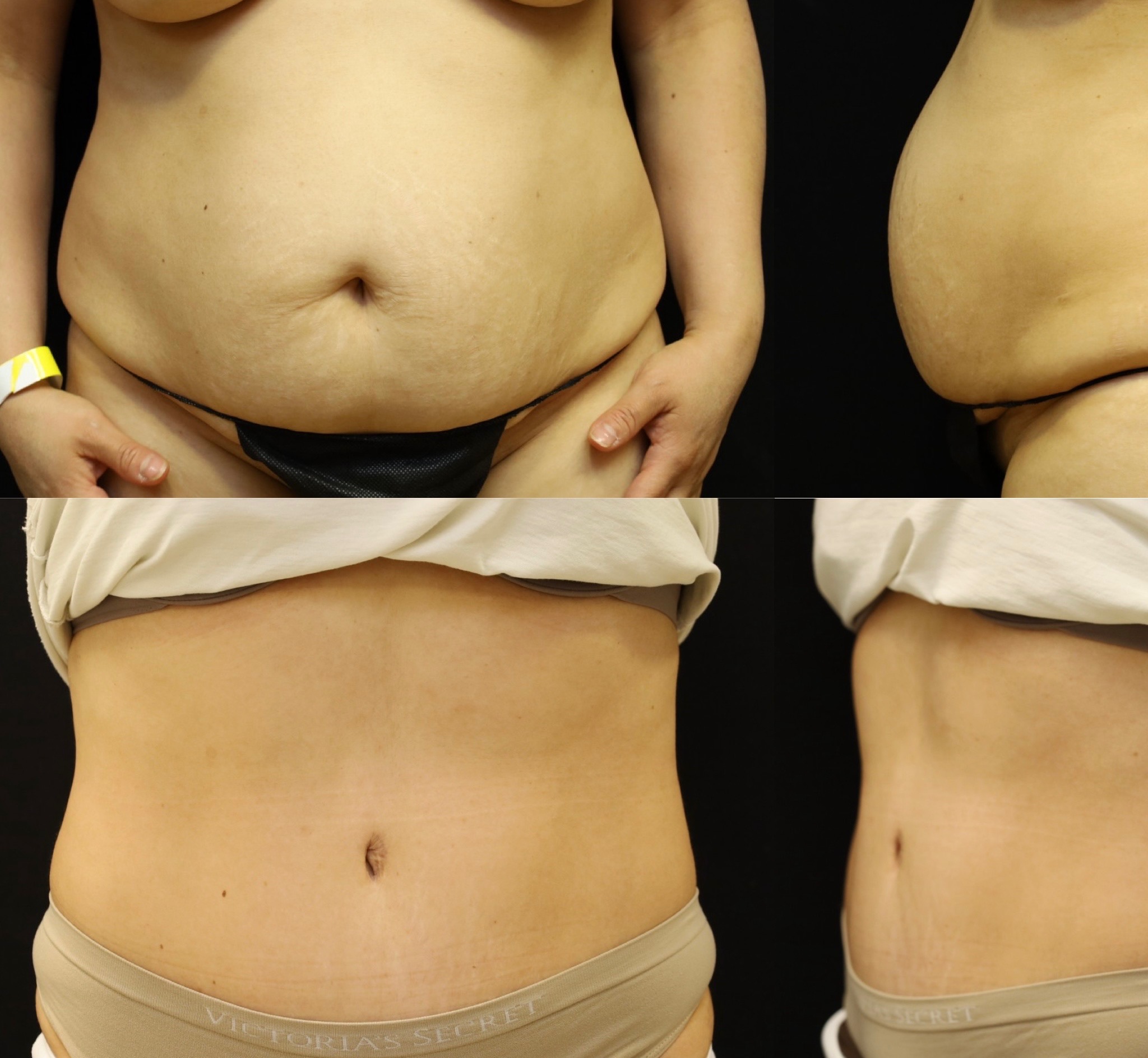 Abdominoplasty Case 16