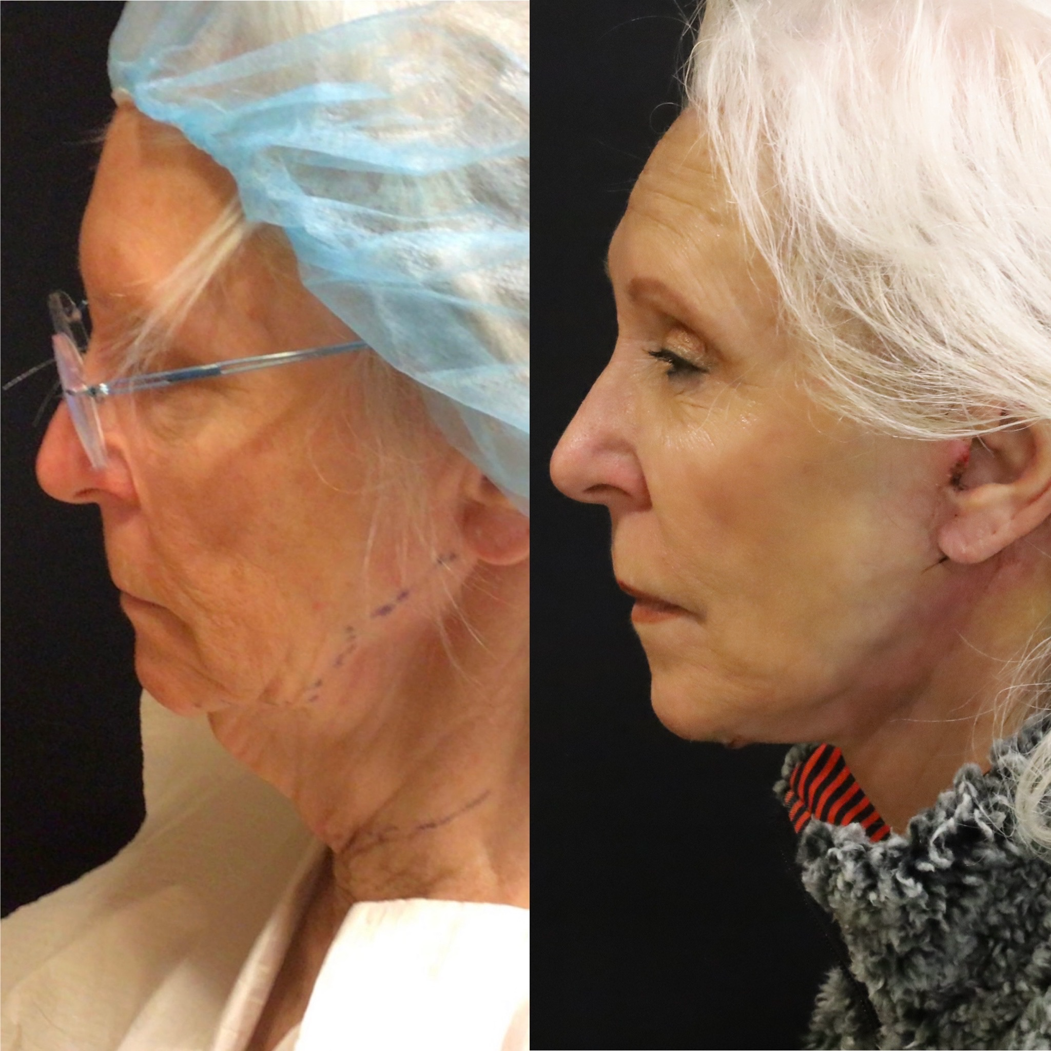 Neck Lift Case 5
