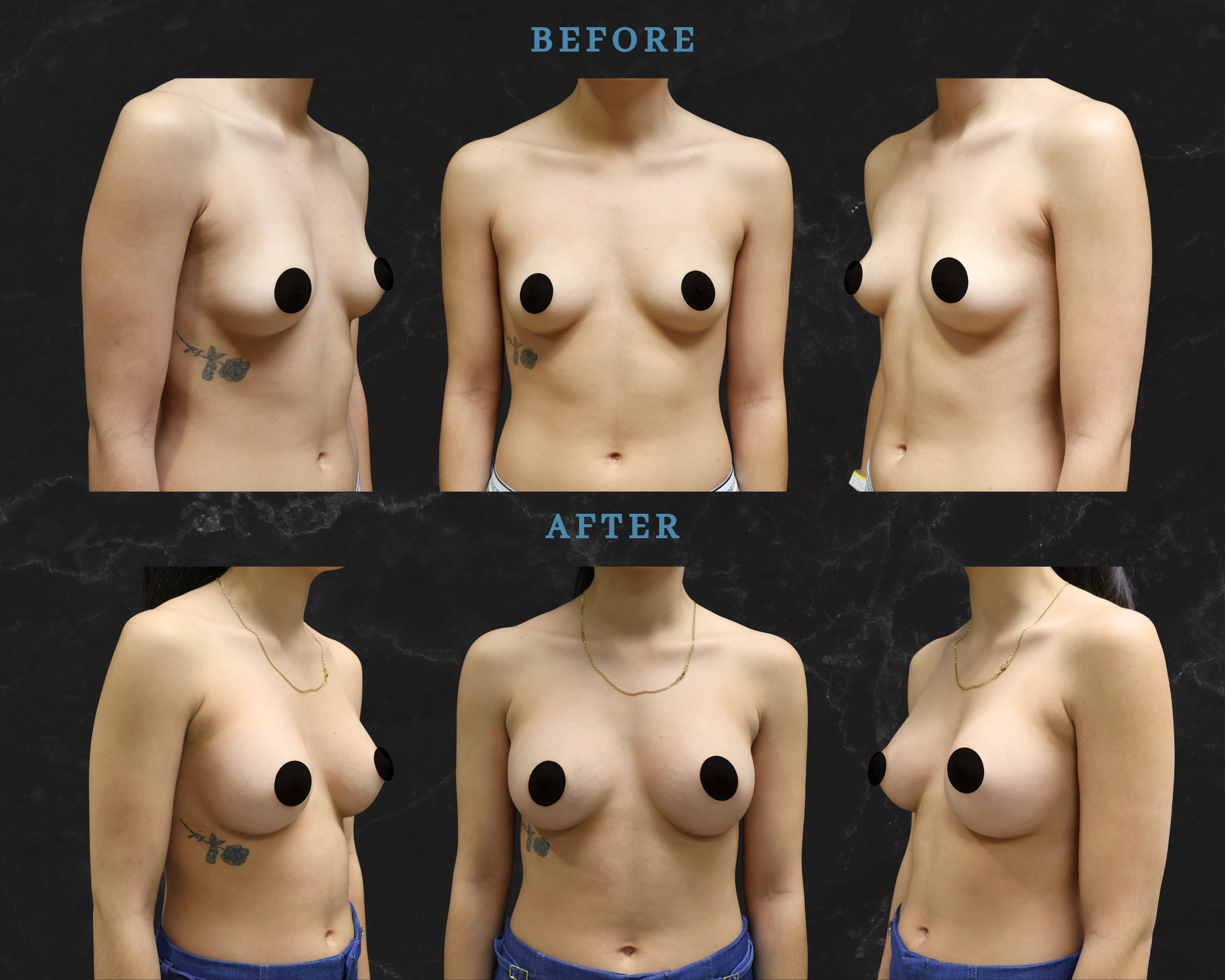 Breast Augmentation Mini Motiva Implants