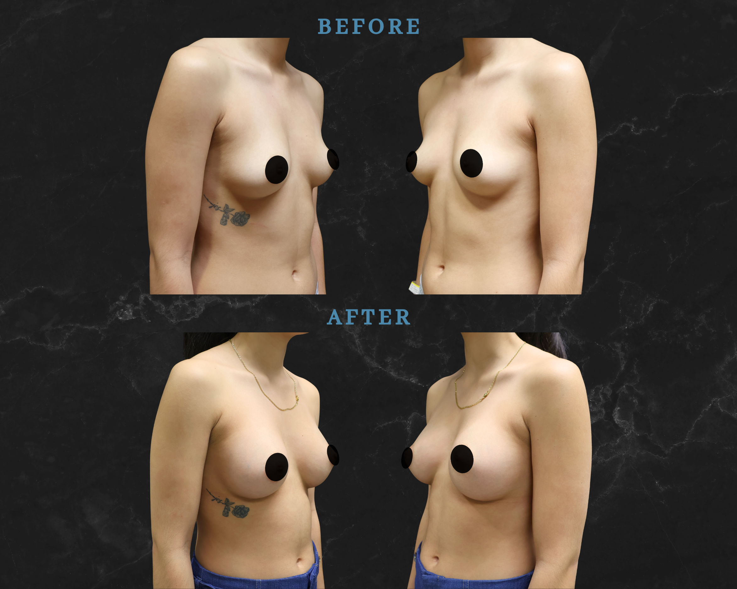 Breast Augmentation Mini Motiva Implants