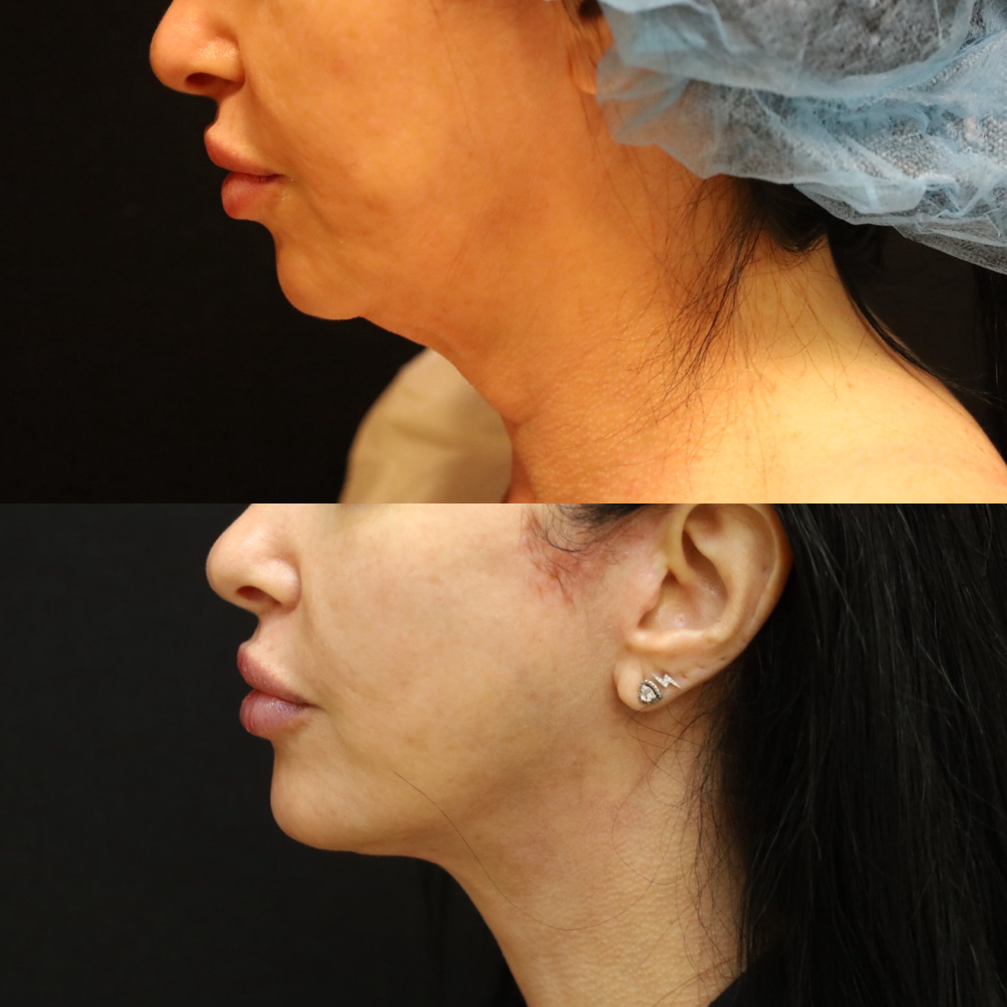 Face & Necklift Case 1