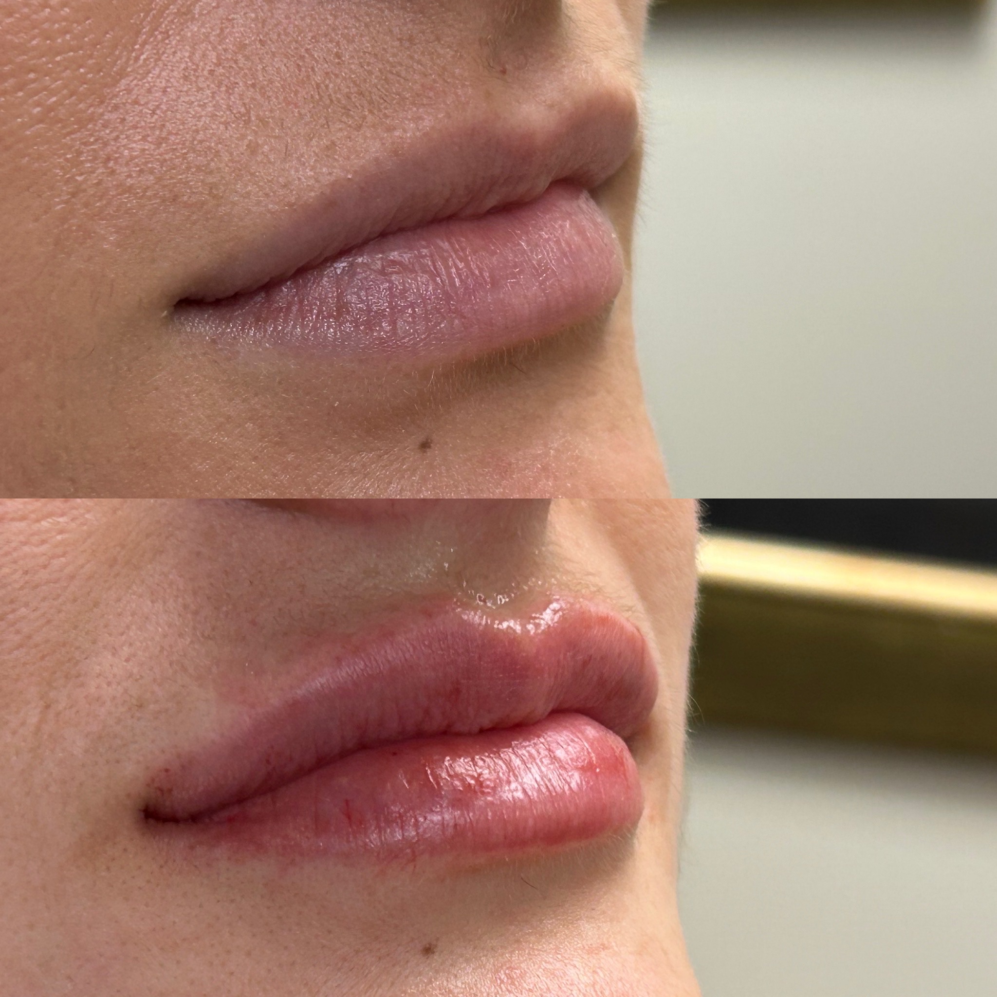 Lip Filler Case 10