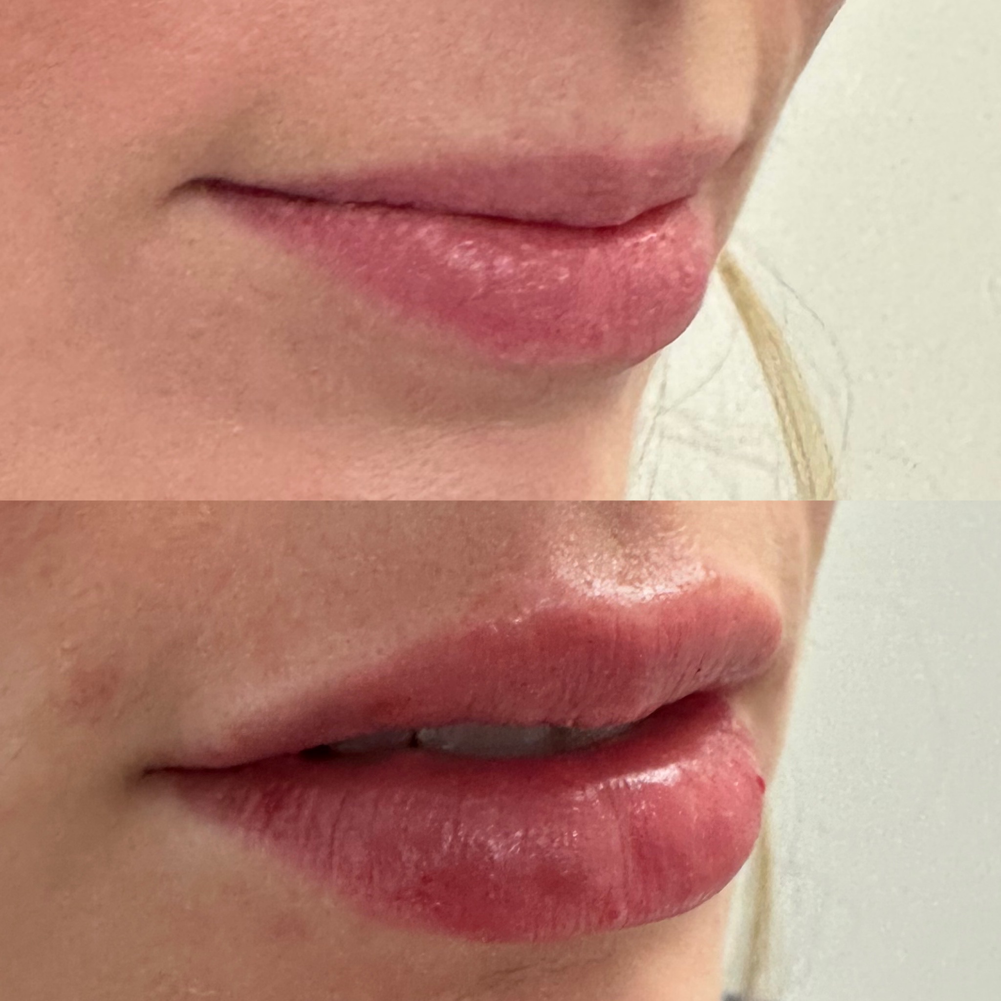Lip Filler Case 11