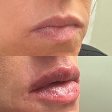 Lip Filler Case 12