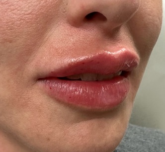 Lip Filler Case 13