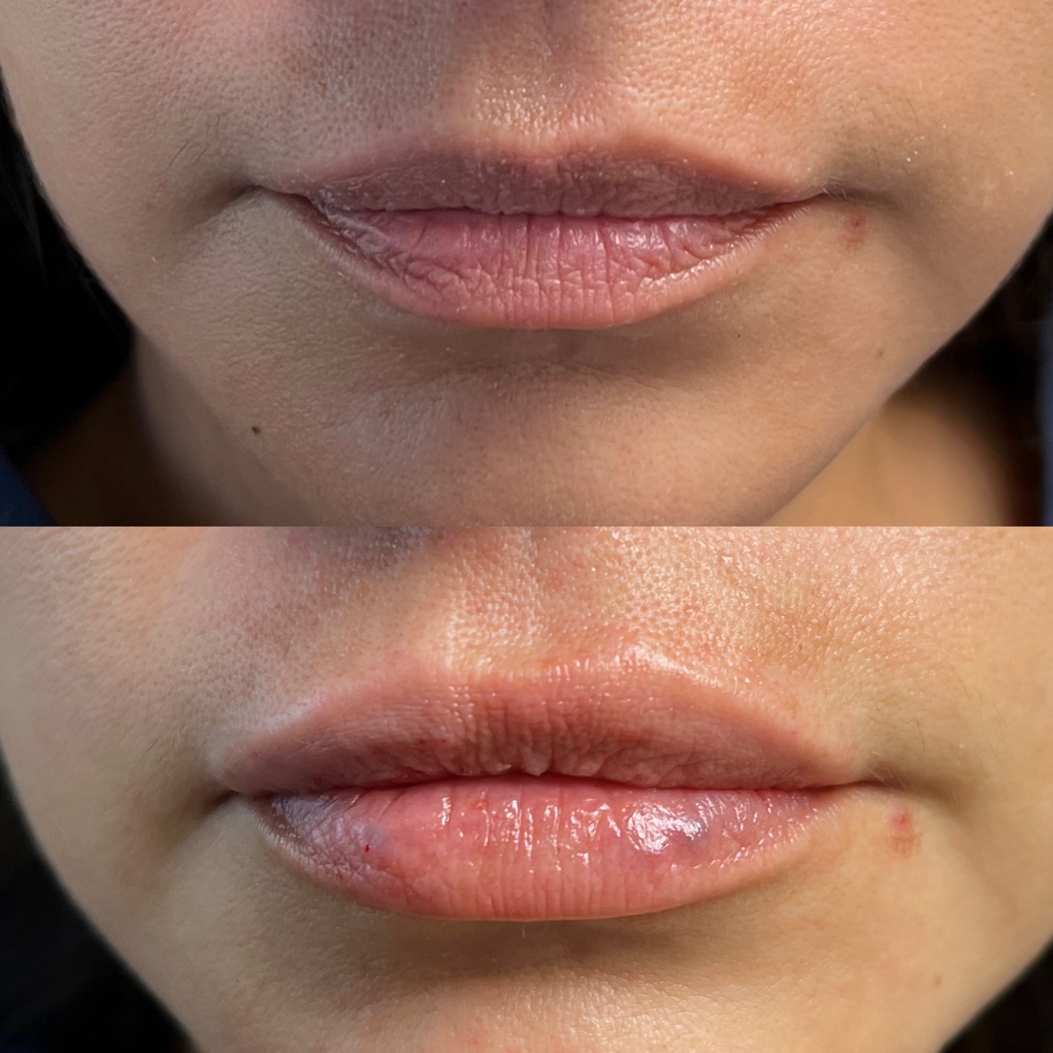 Lip Filler Case 15