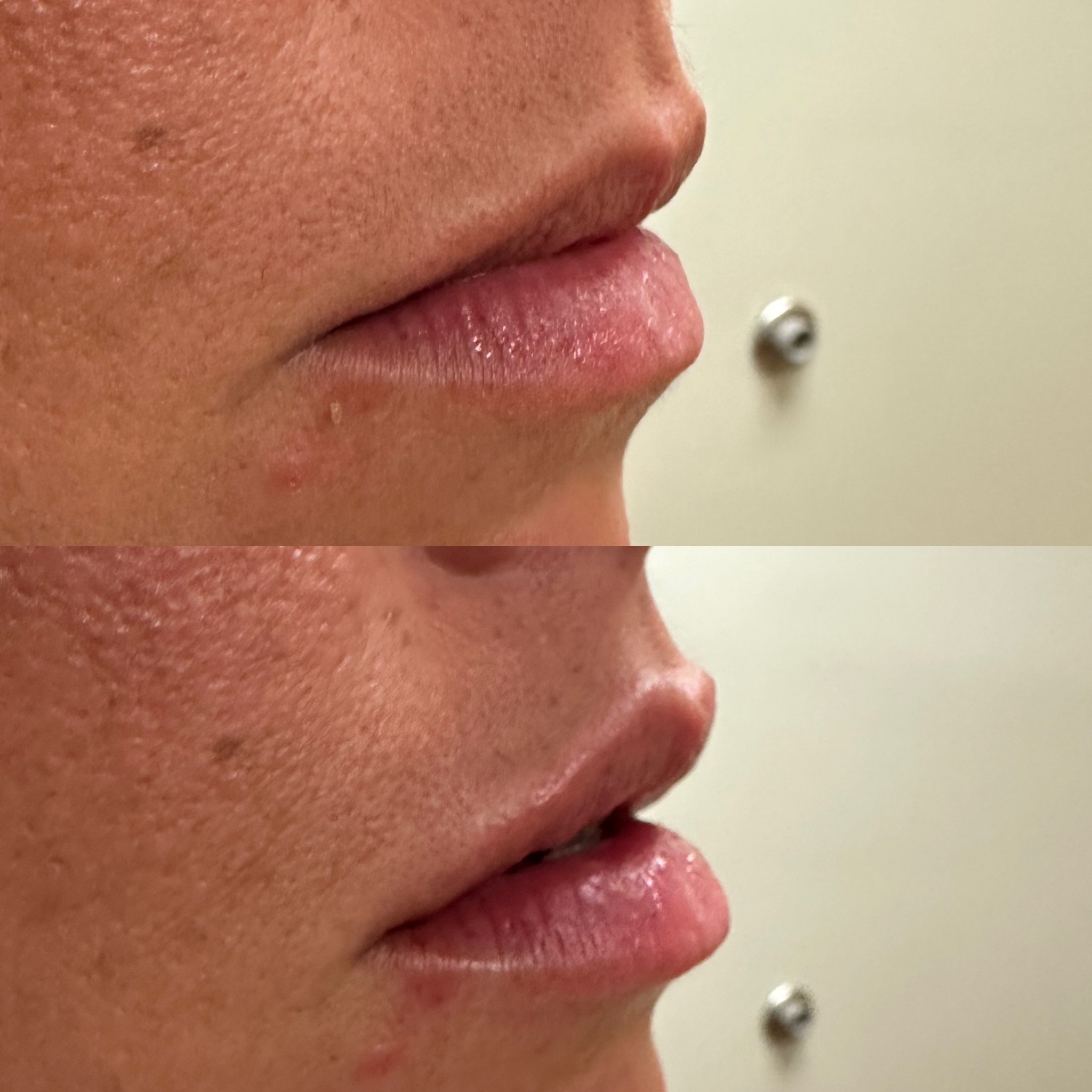 Lip Filler Case 16