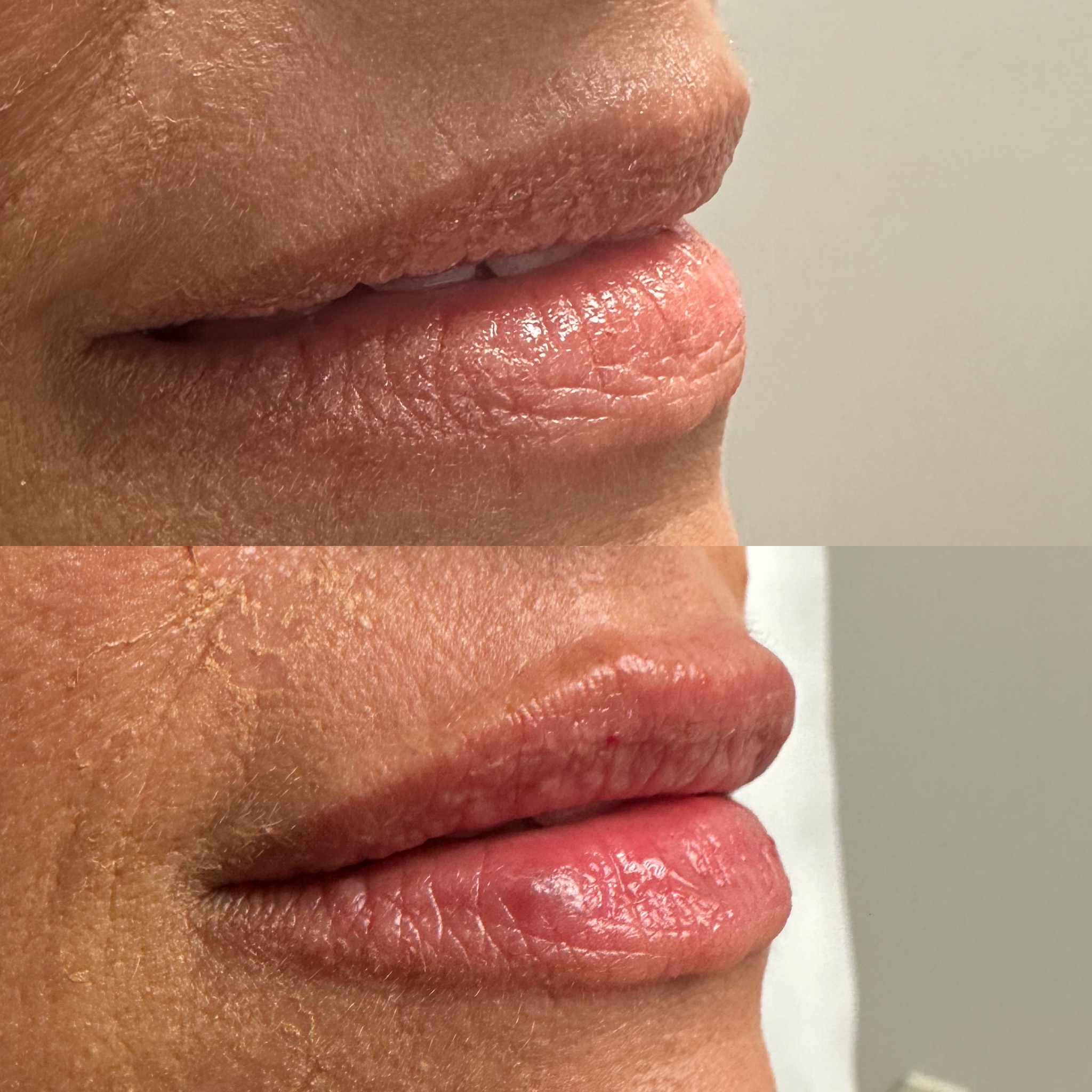 Lip Filler Case 3