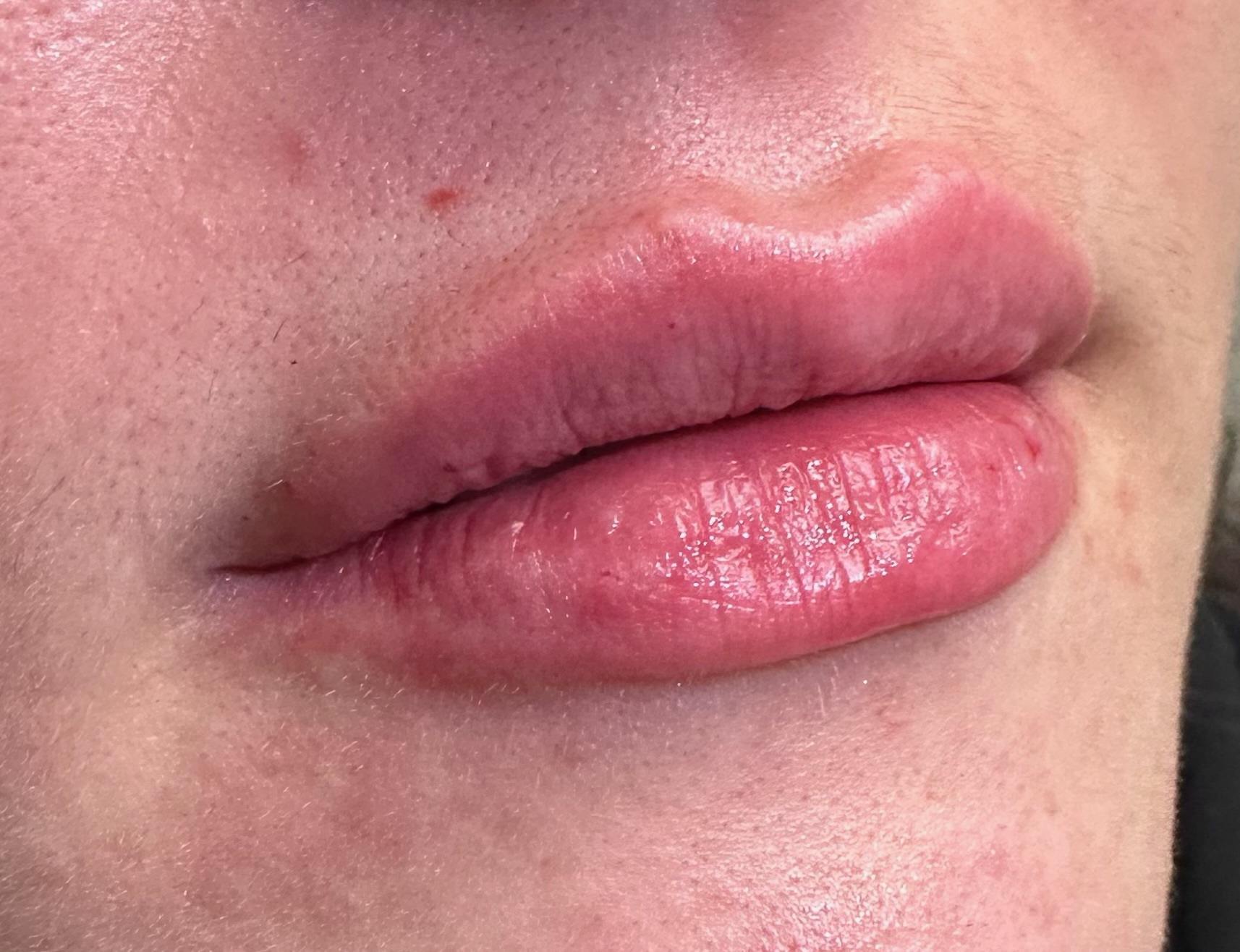Lip Filler Case 4