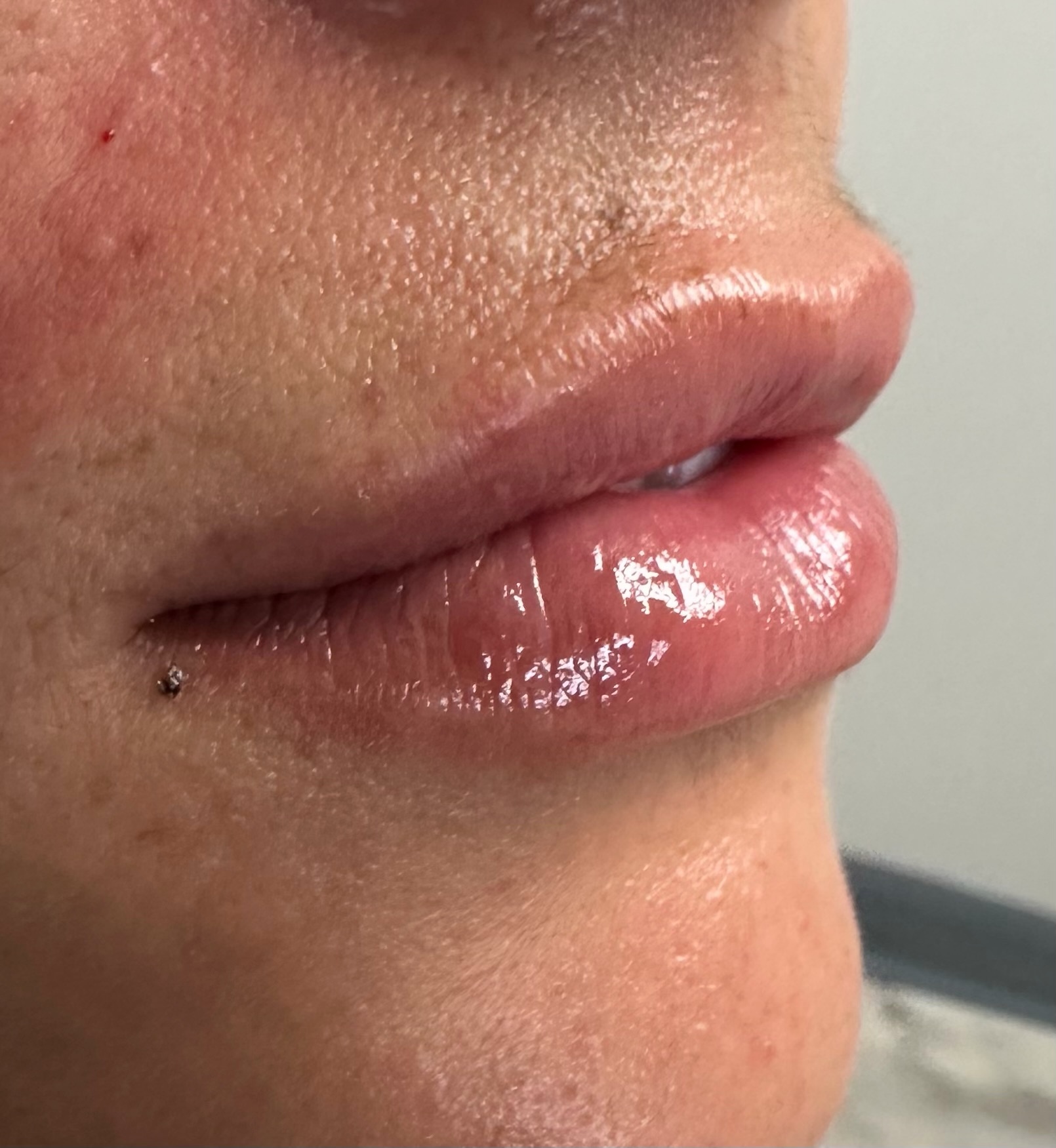 Lip Filler Case 7