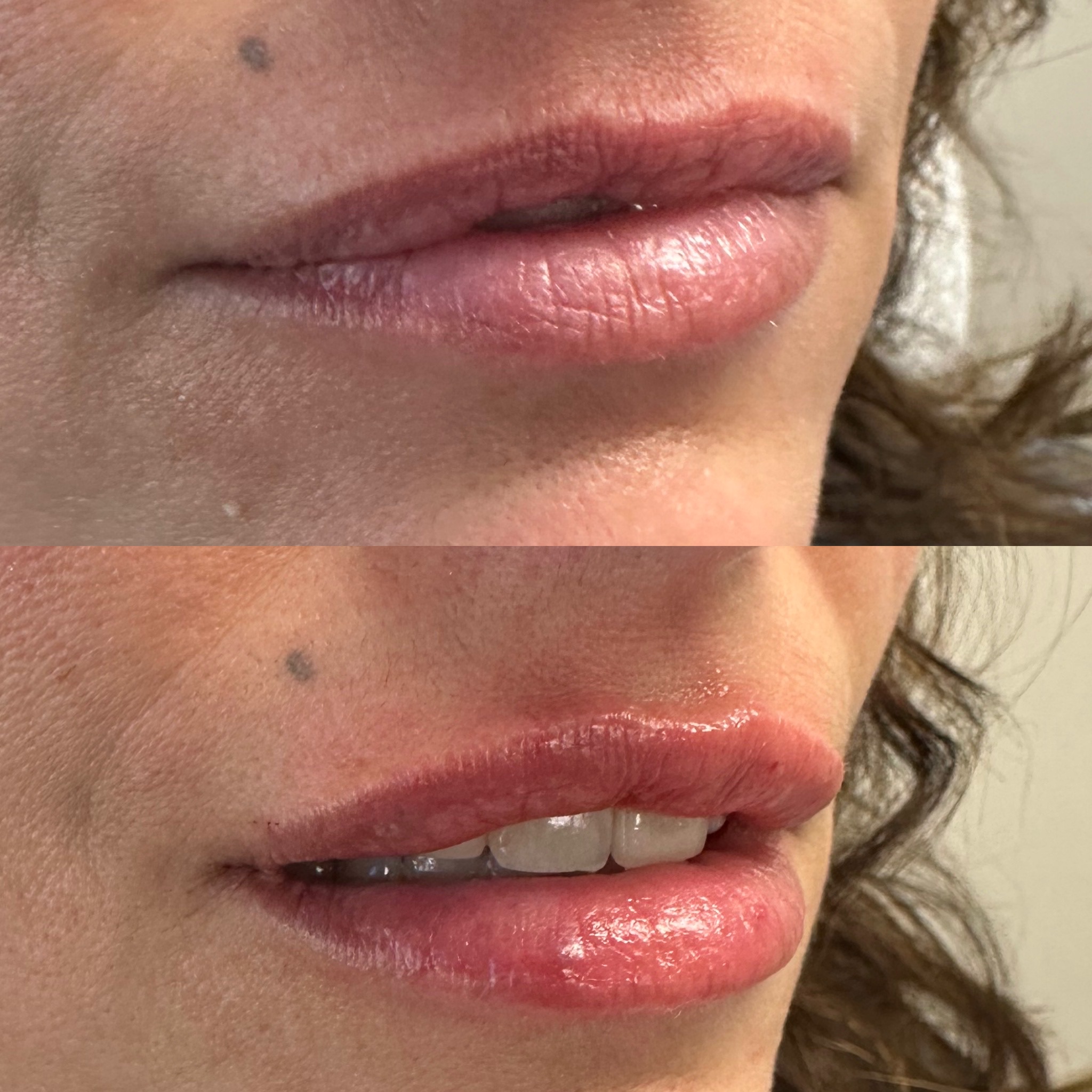 Lip Filler Case 8