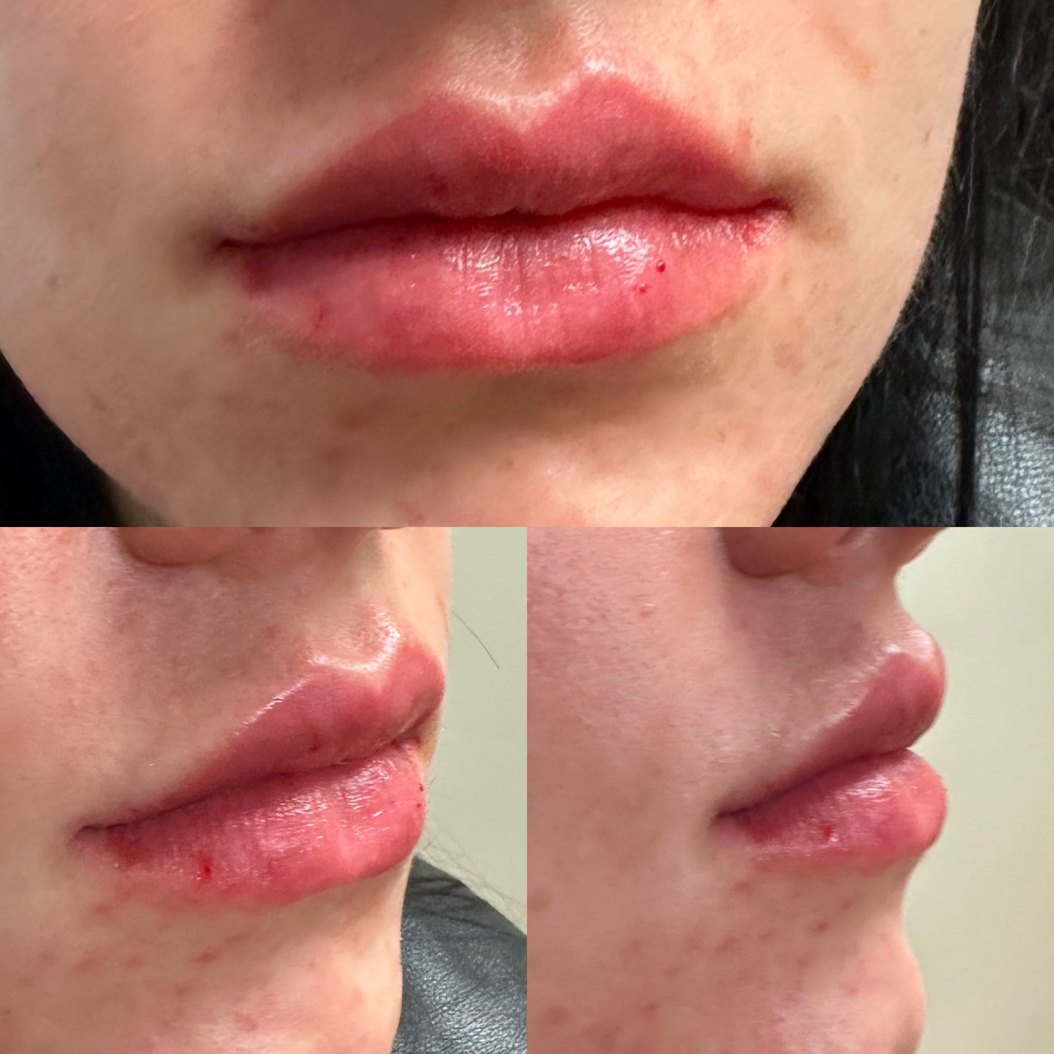 Lip Filler Case 9