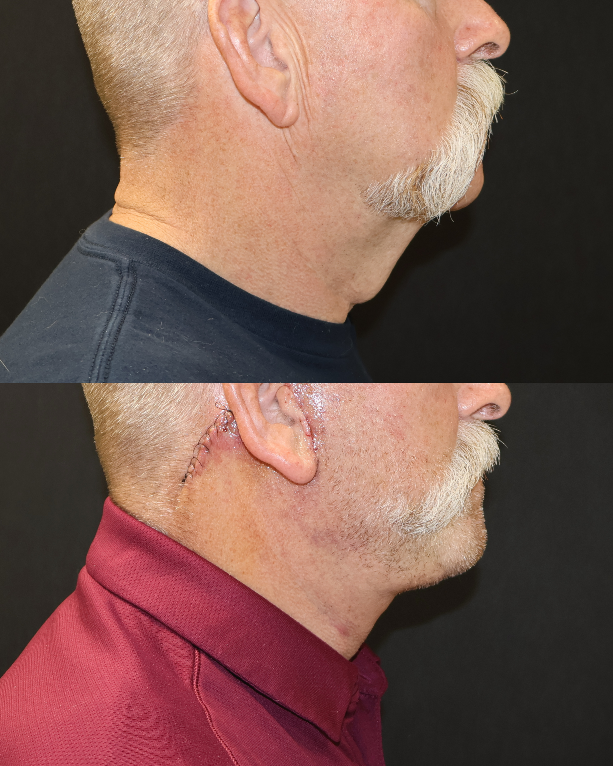 Face and Neck Lift Case 2