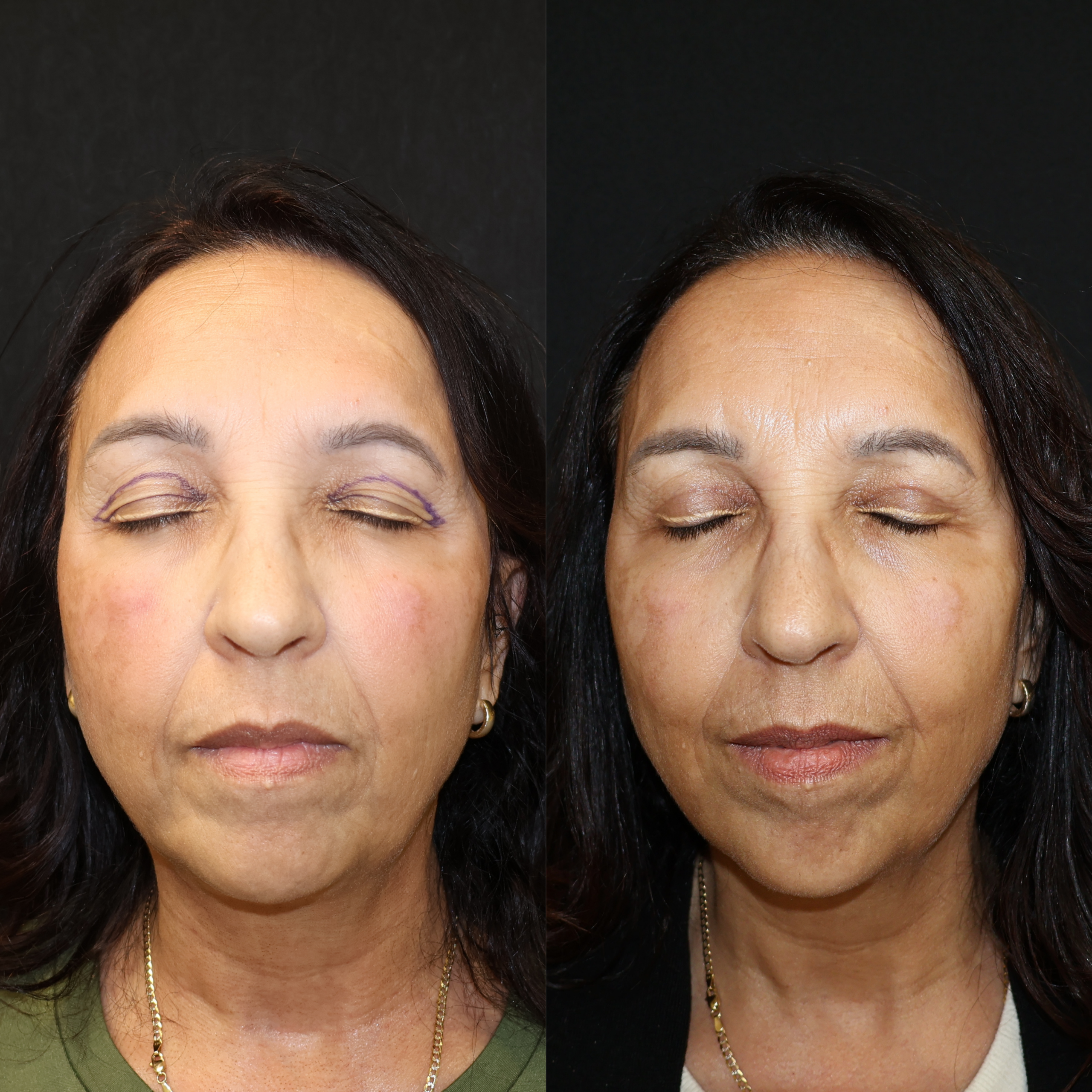 Upper Blepharoplaty Case 13