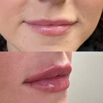 Lip Filler Case 18