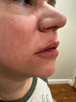 Lip Filler Case 19
