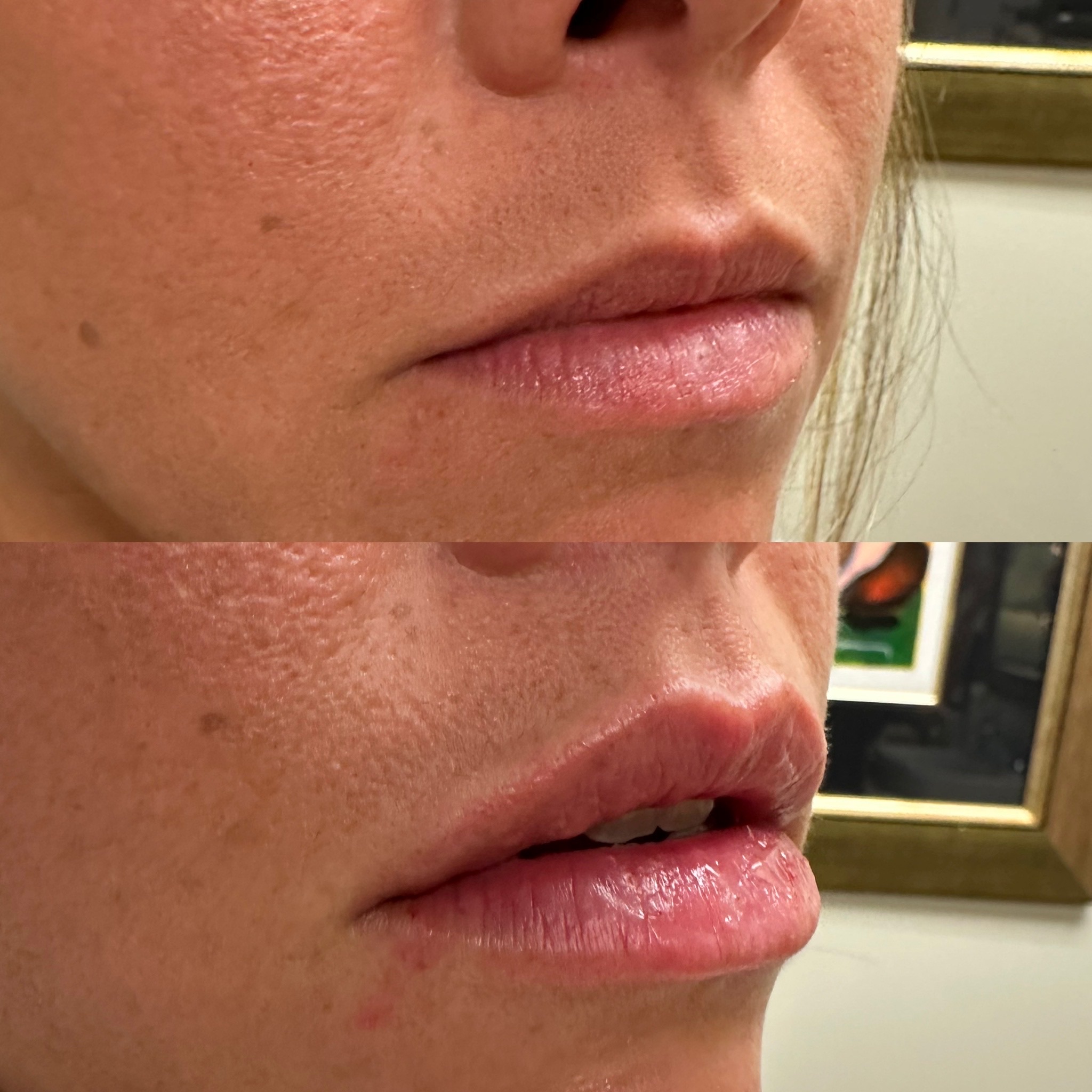 Lip Filler Case 21
