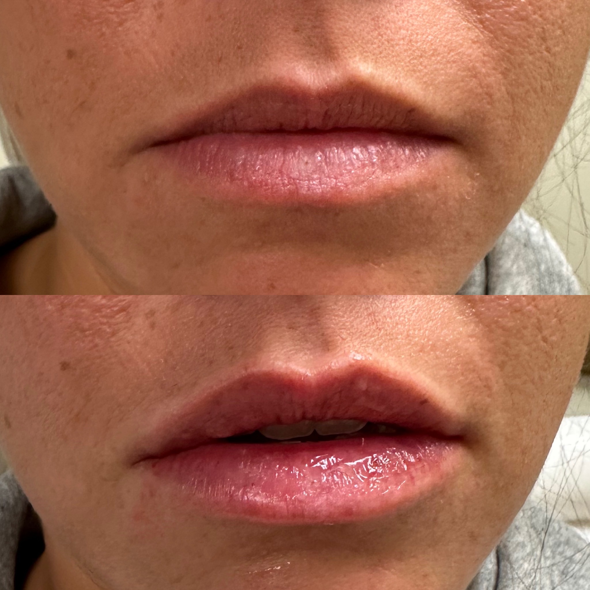 Lip Filler Case 22