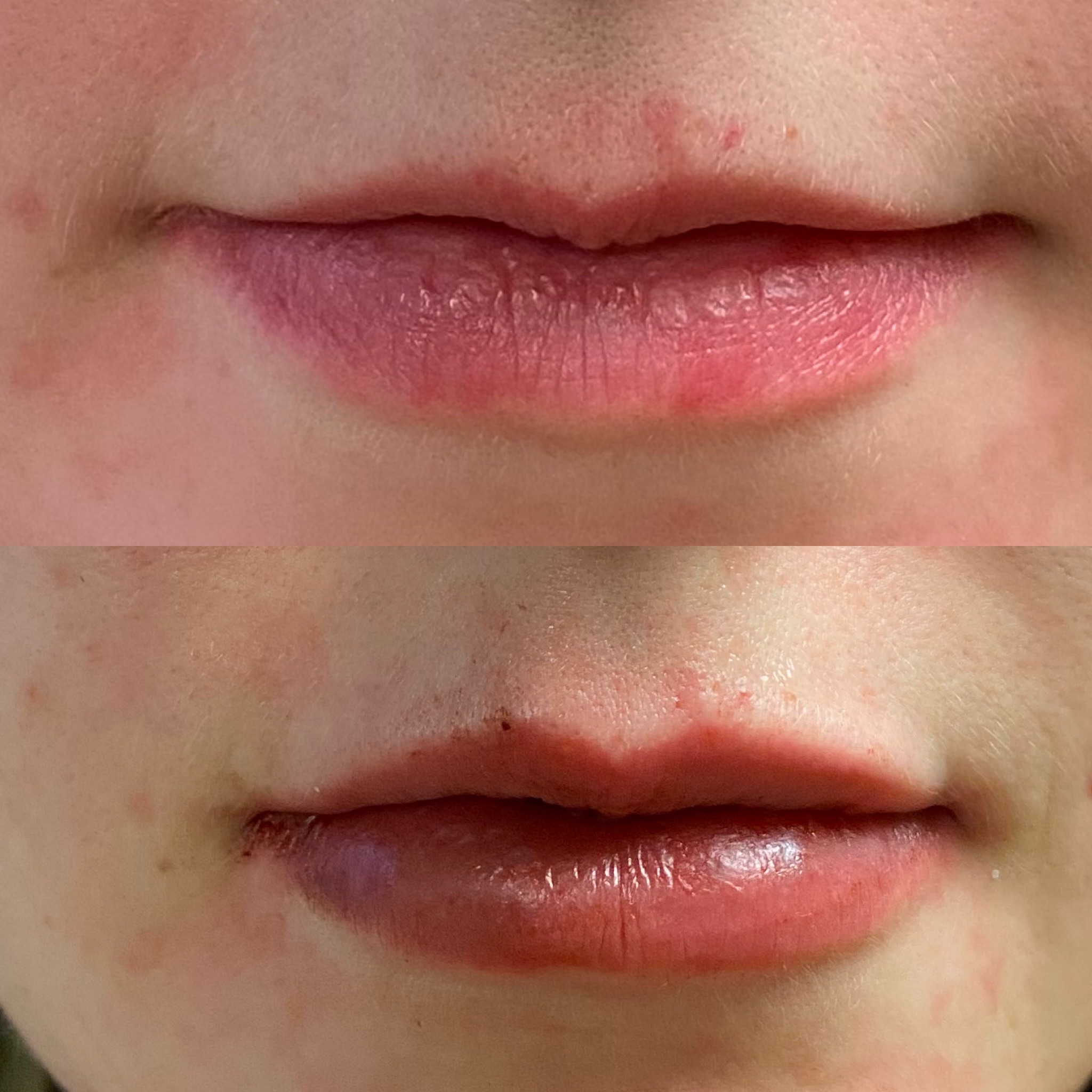 Lip Filler Case 23