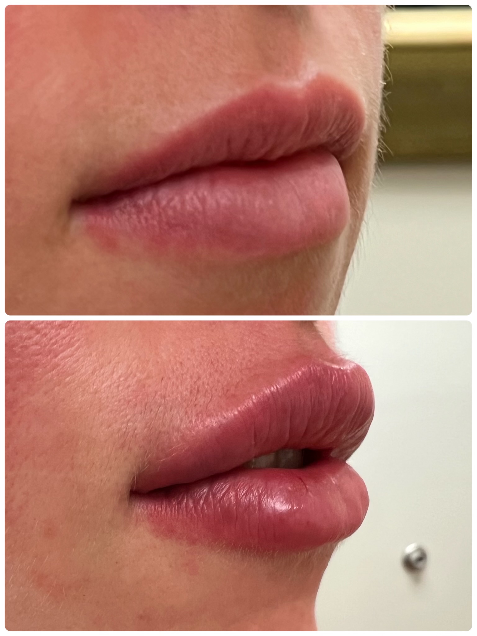 Lip Filler Case 24