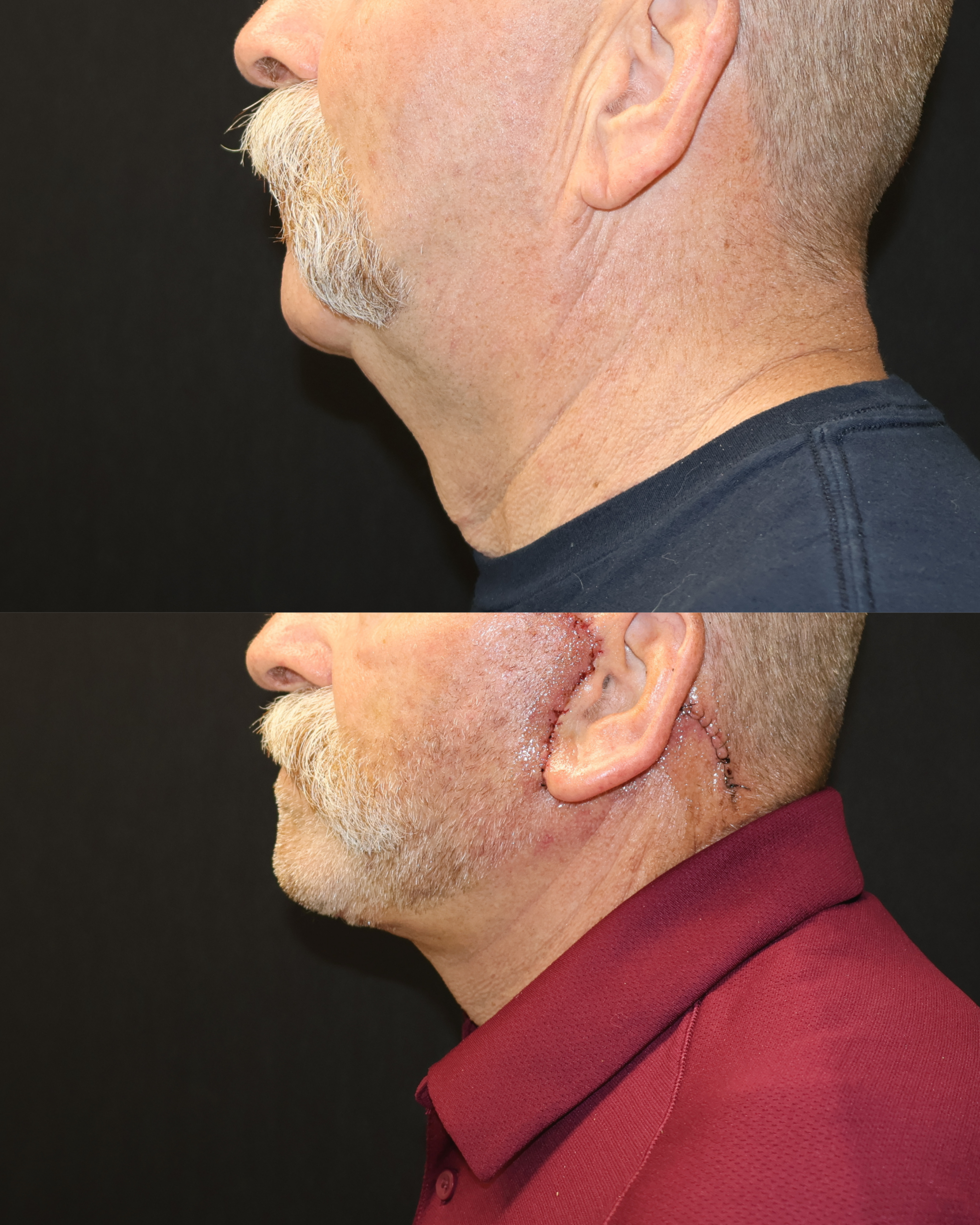 Face and Neck Lift Case 2
