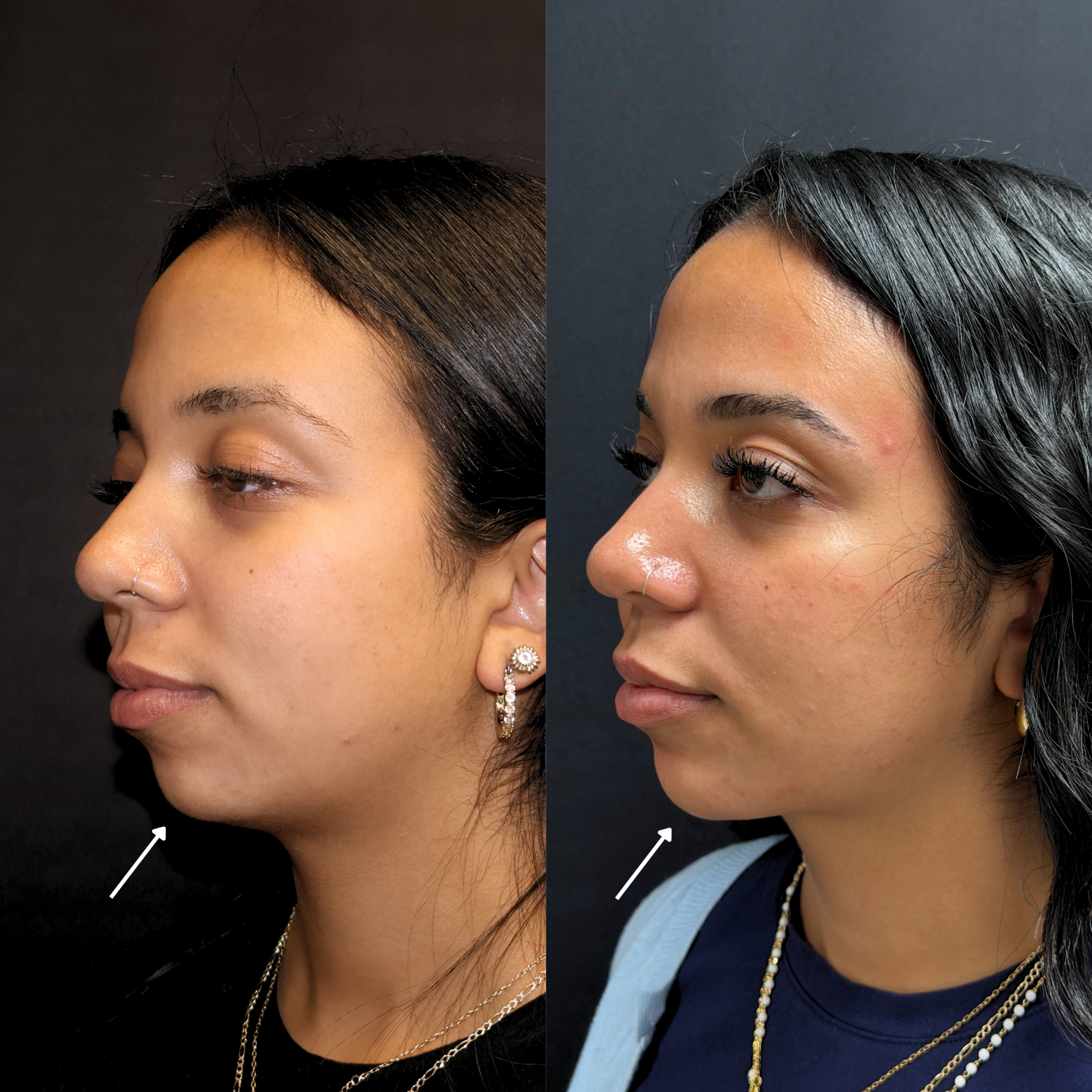 Submental Lipo + Chin/ Jawline Filler