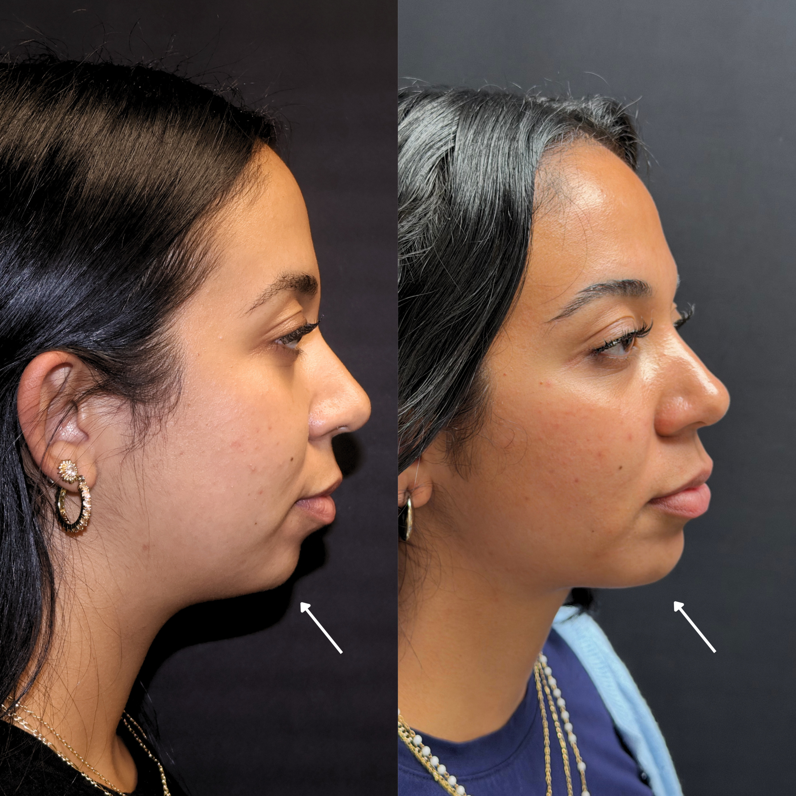 Submental Lipo + Chin/ Jawline Filler