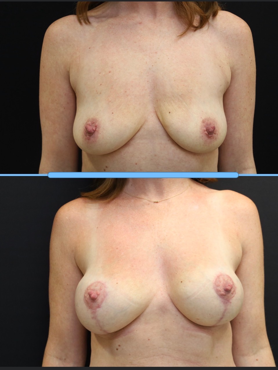 Breast Augmentation with Lift Case 1
