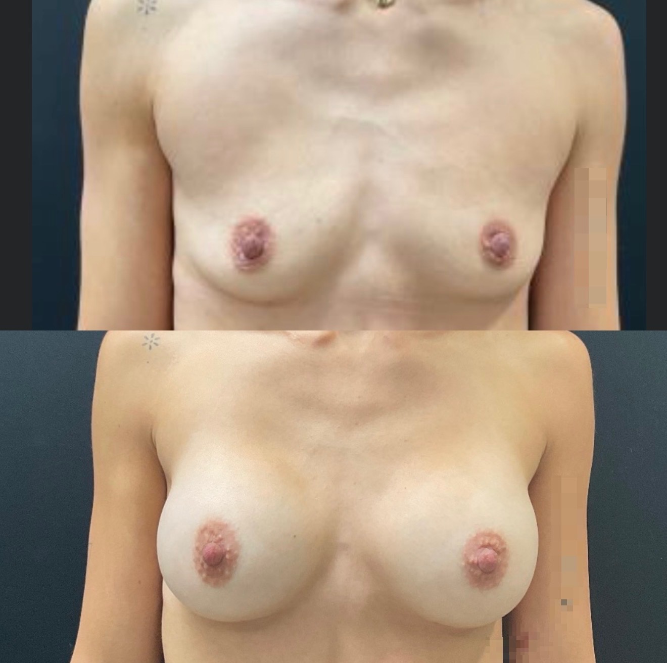 Breast Augmentation Case 12
